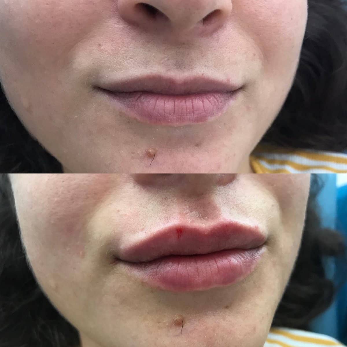 Case 18314 - lip lift