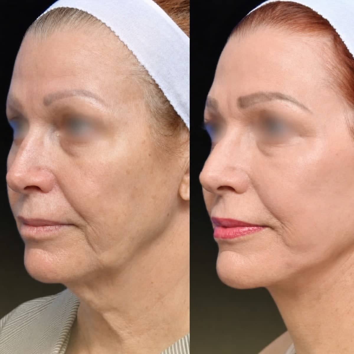 Case 18321 - brow lift