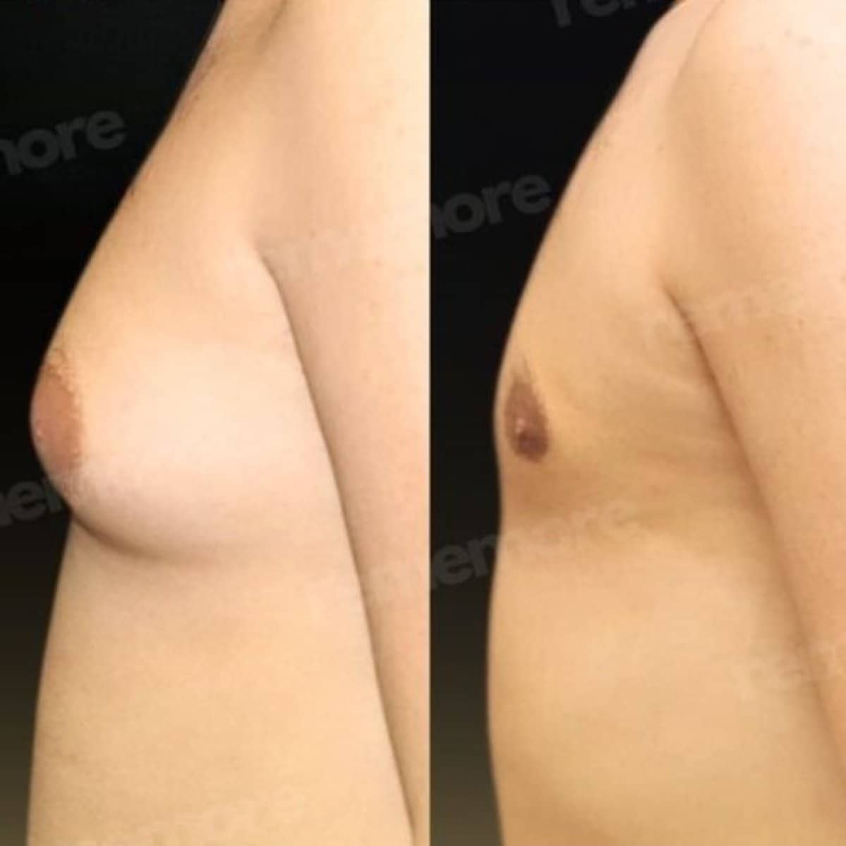 Case 18323 - gynecomastia surgery