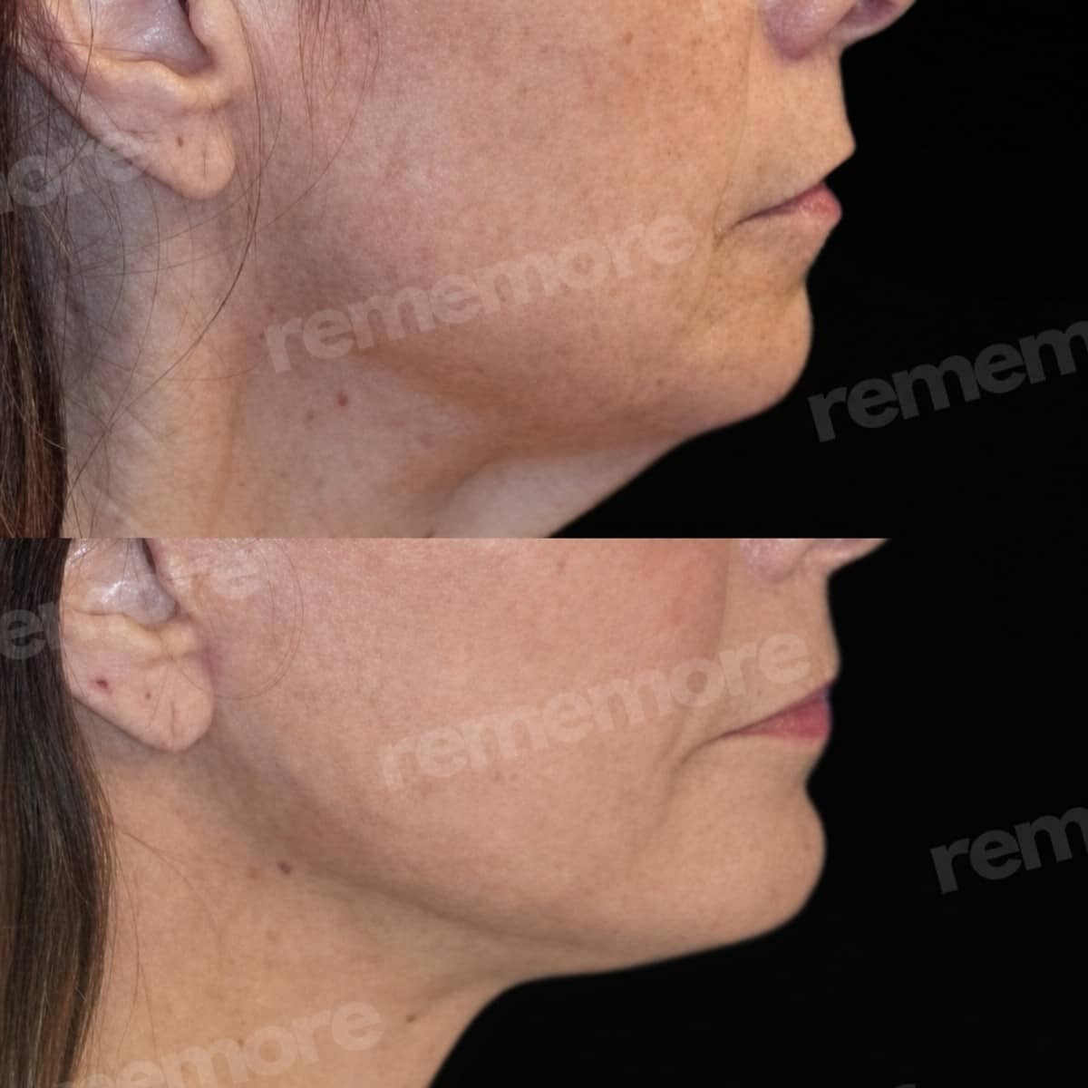 Case 18324 - chin liposuction