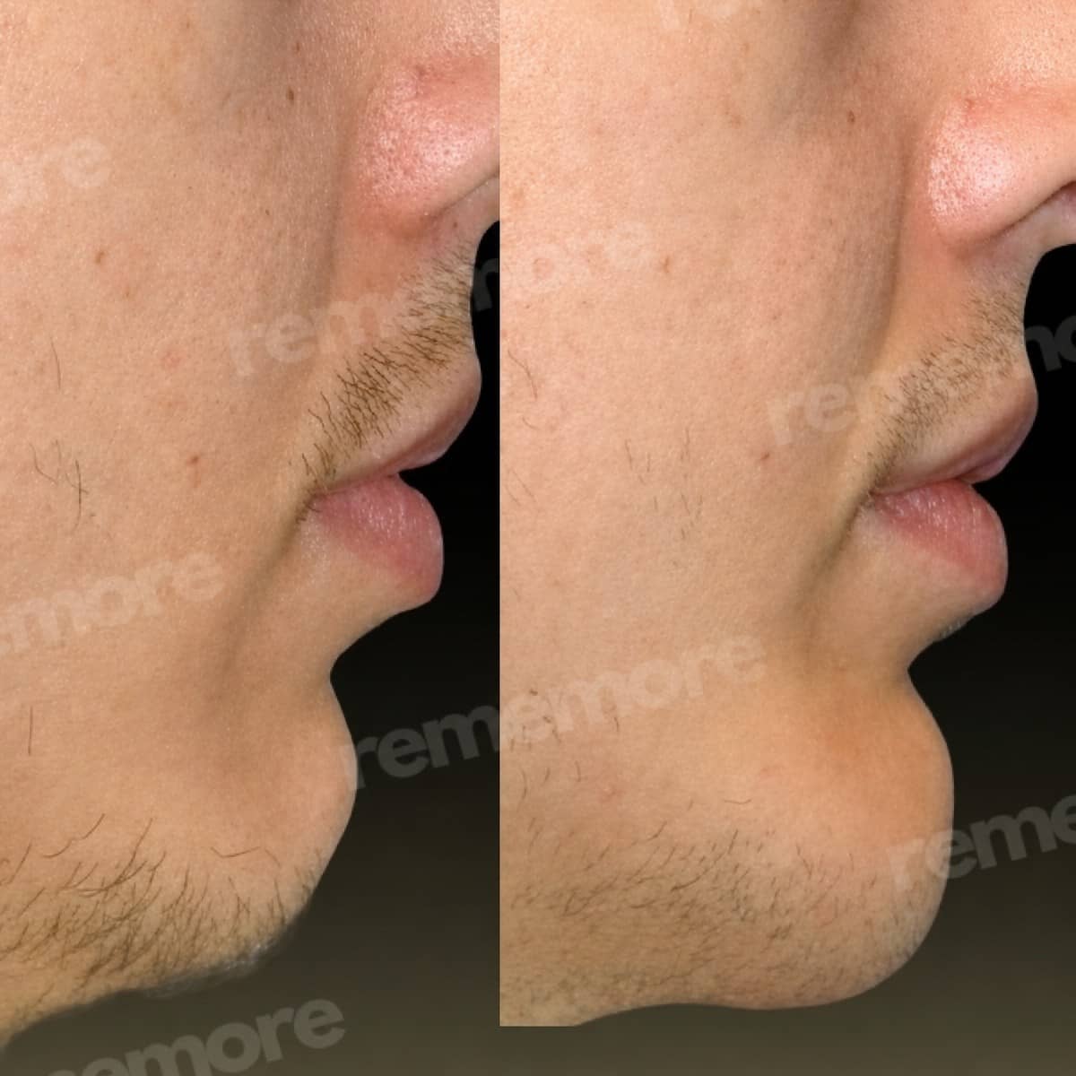 Case 18325 - chin implant