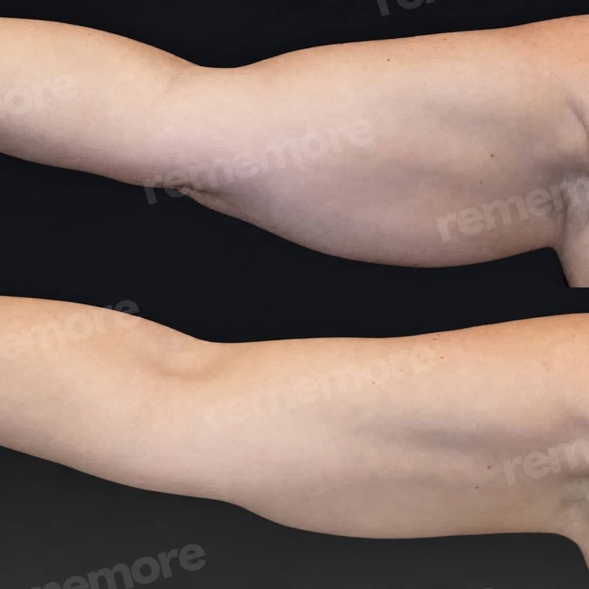 Case 18326 - arm lift