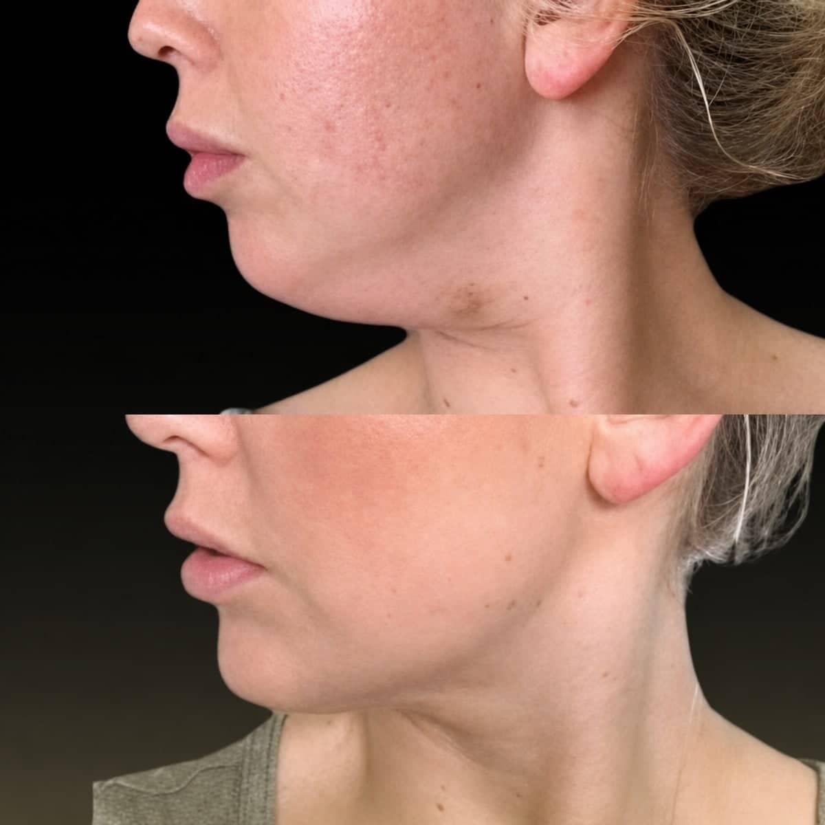 Case 18327 - chin liposuction