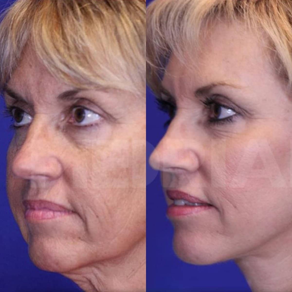Case 18329 - neck lift