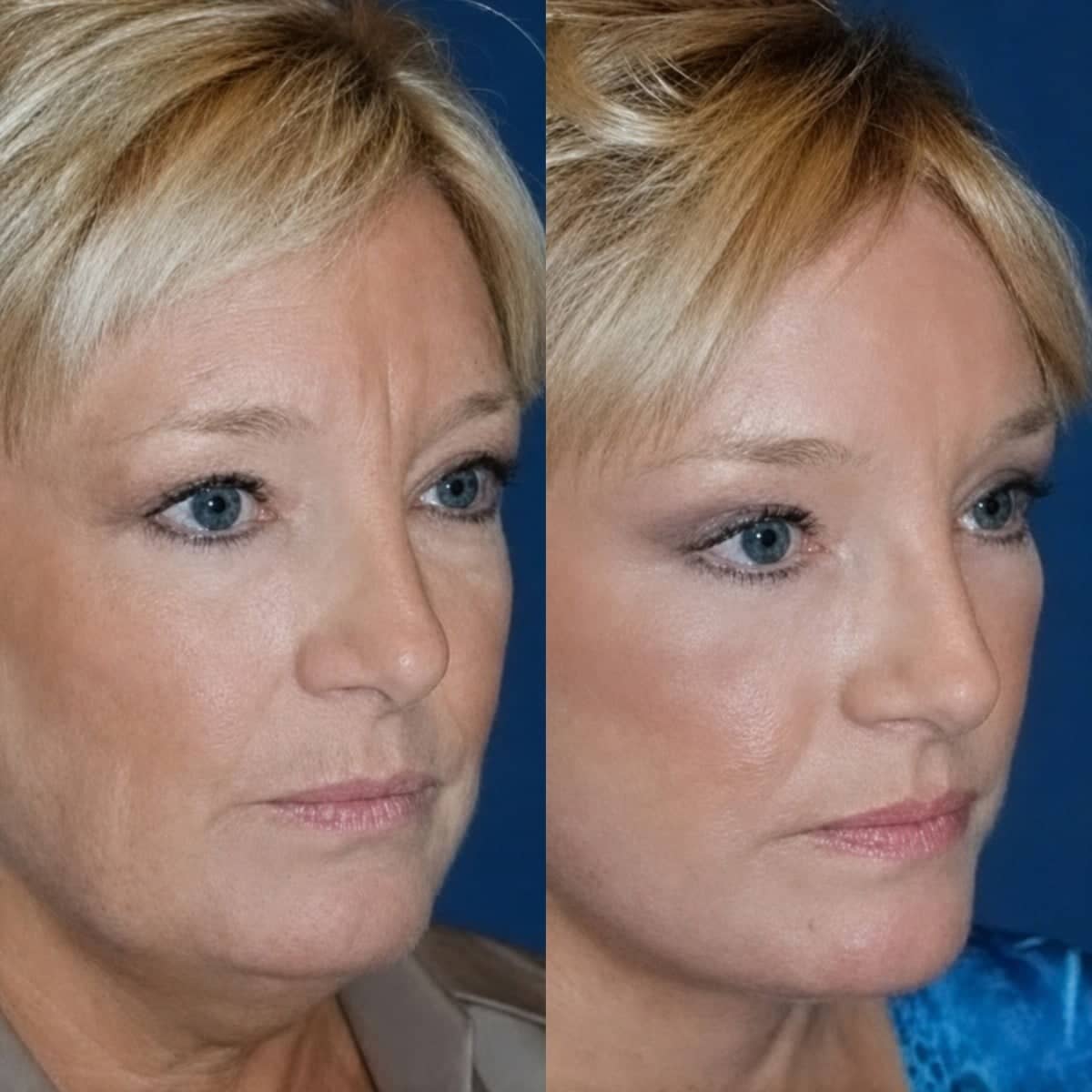 Case 18331 - neck lift