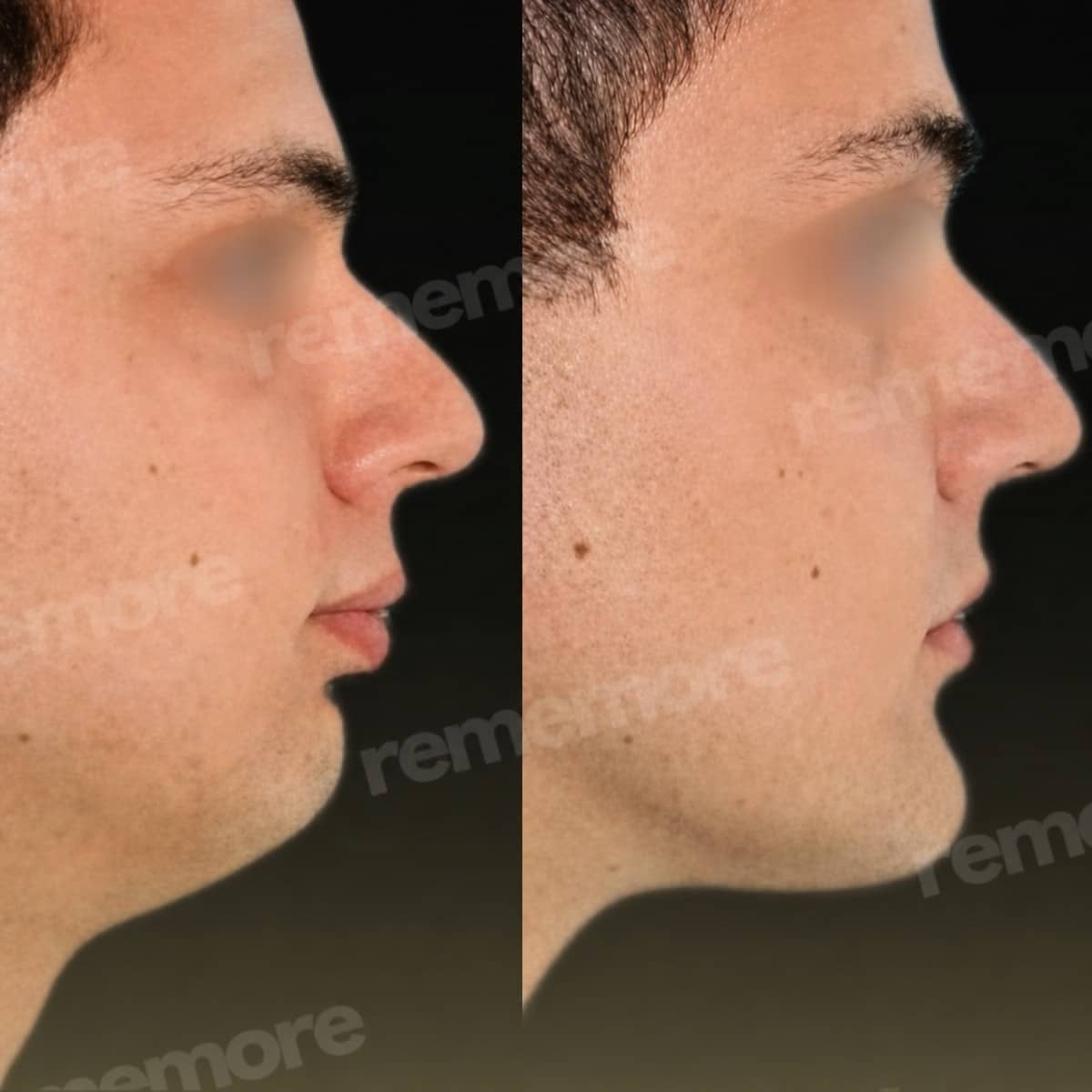 Case 18332 - jaw shaping
