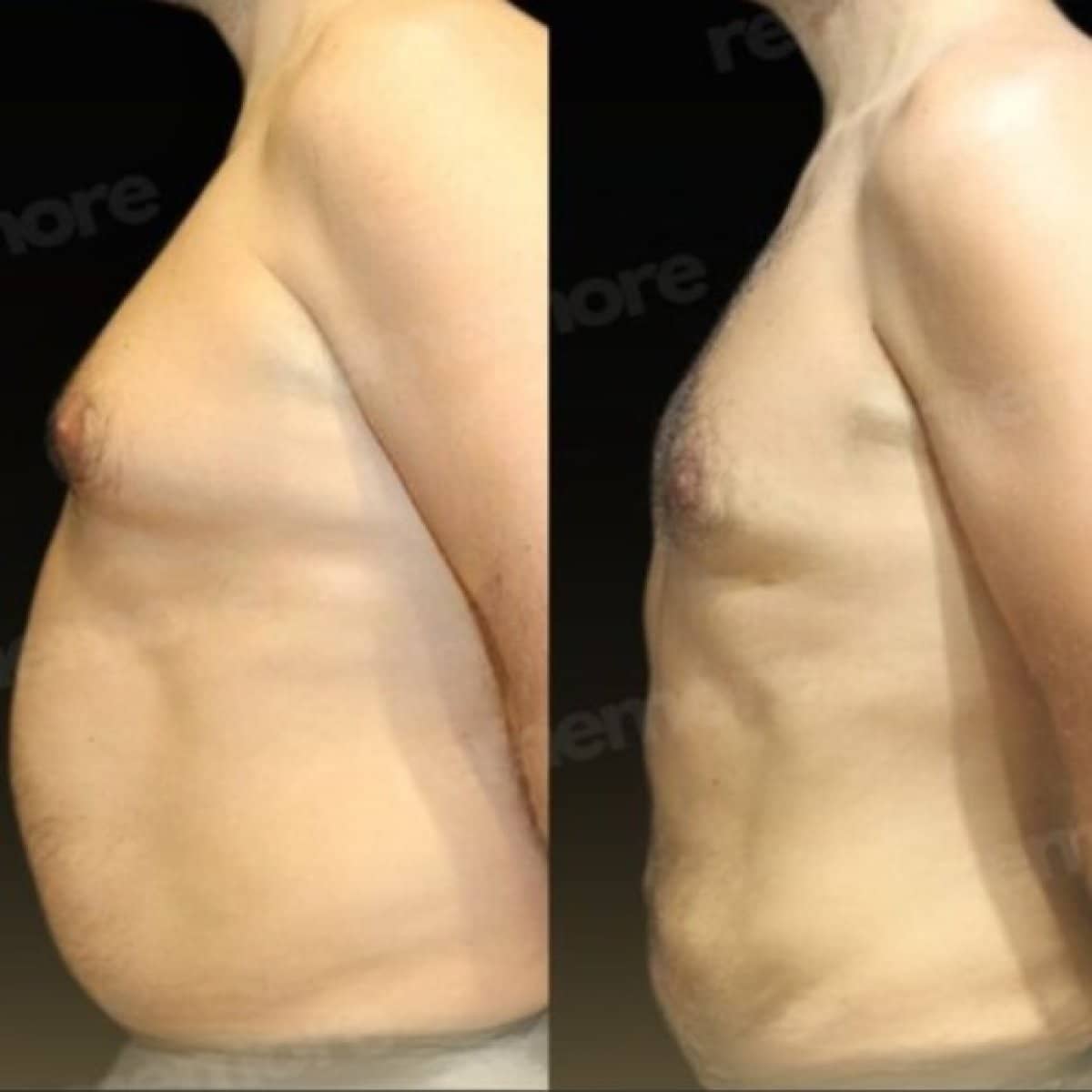 Case 18335 - liposuction