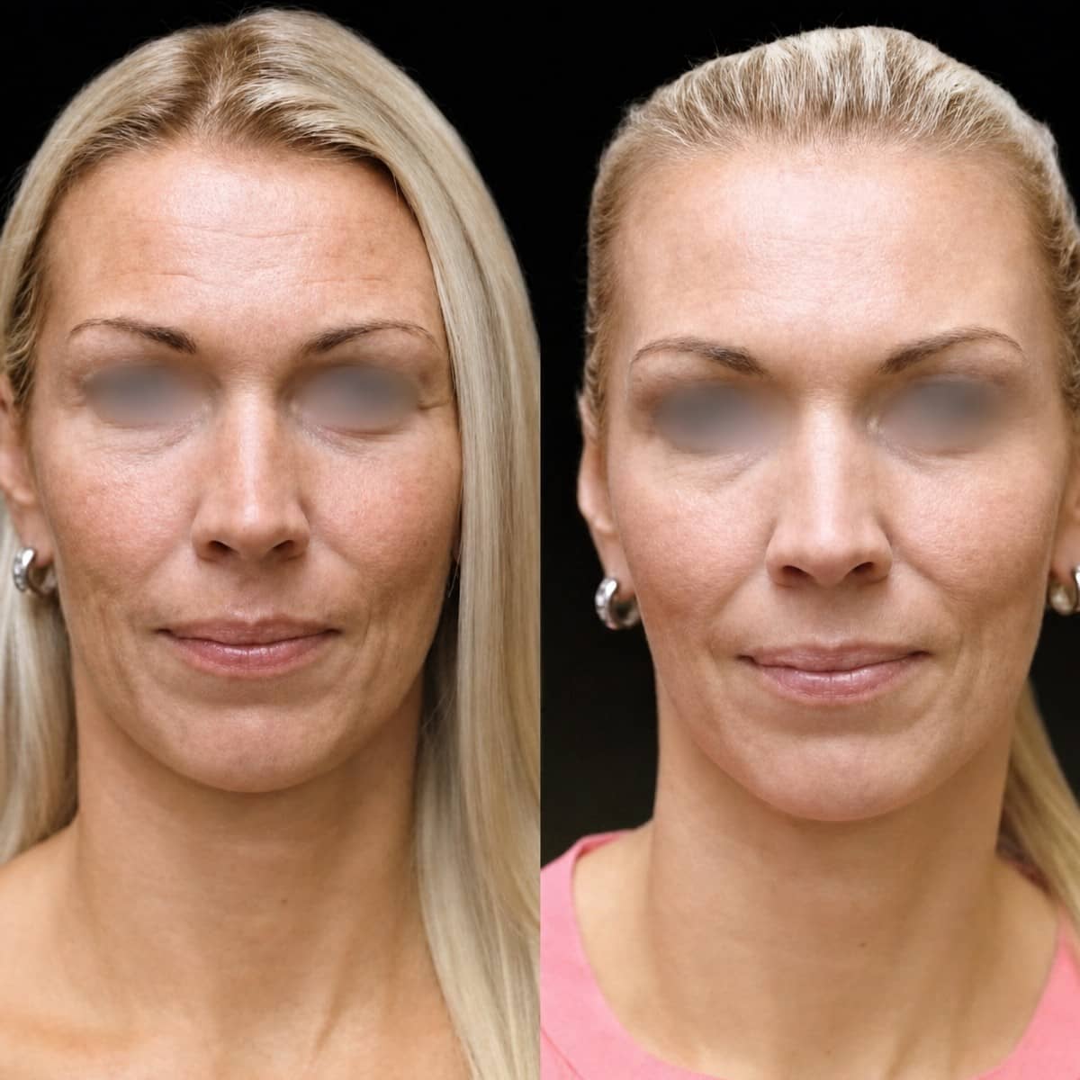 Case 18336 - brow lift