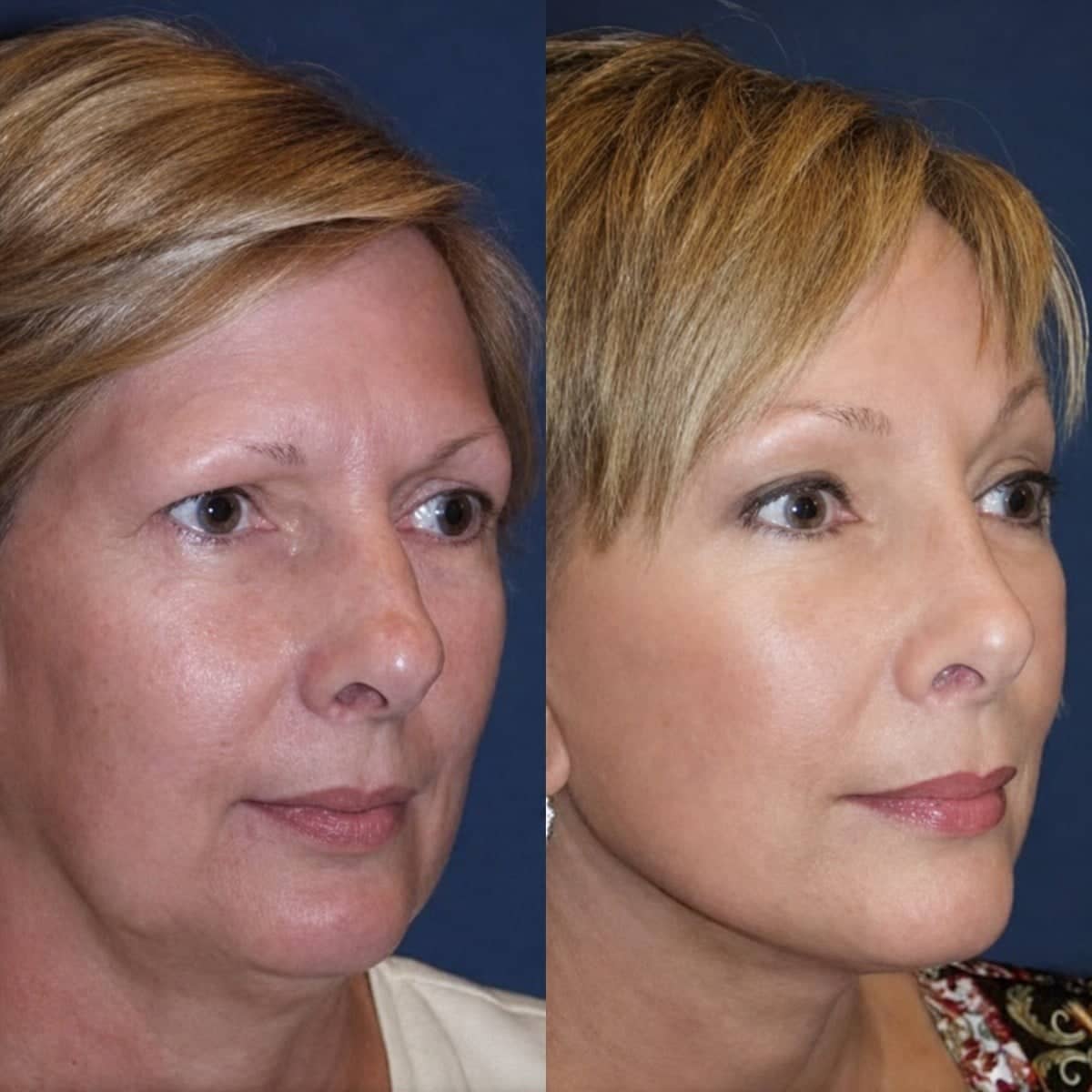 Case 18337 - neck lift