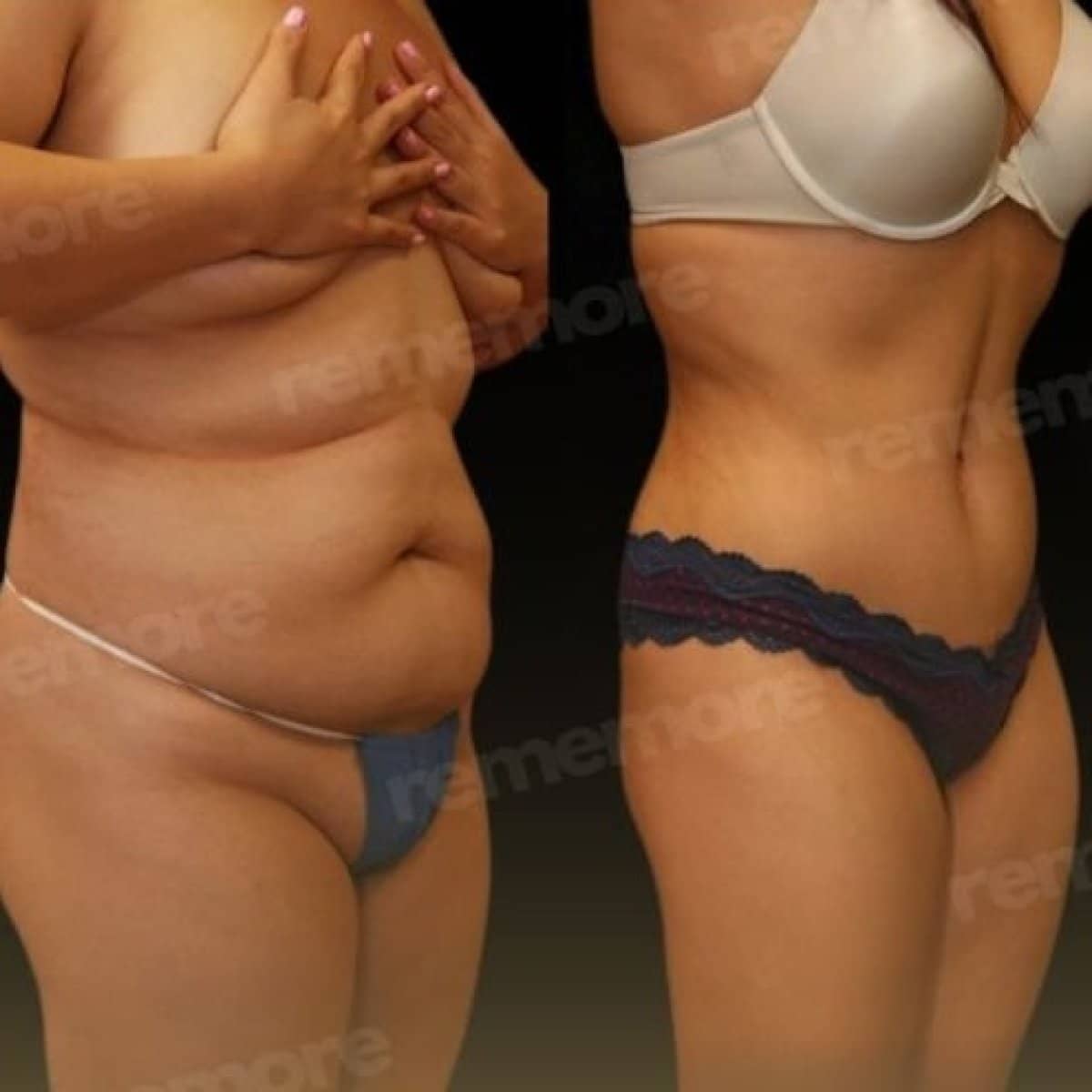 Case 18340 - Vaser liposuction