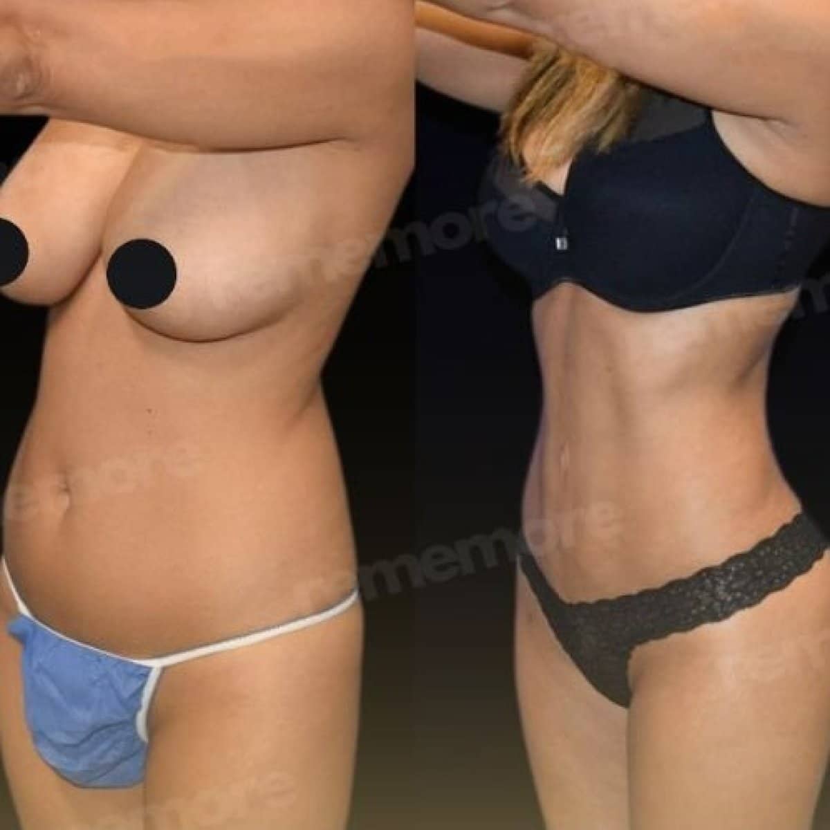 Case 18341 - 360 liposuction