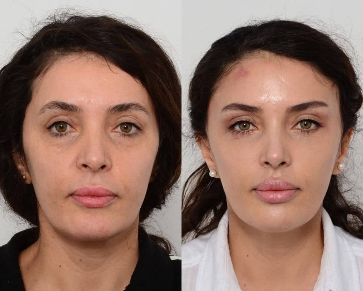 Case 18342 - lower eyelid blepharoplasty