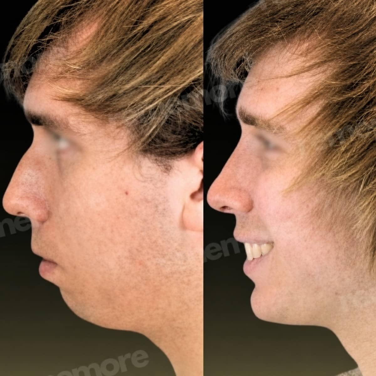 Case 18344 - jaw shaping