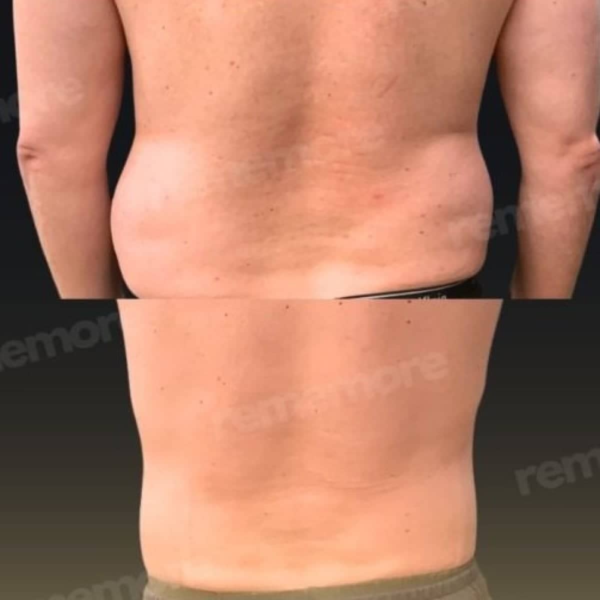 Case 18345 - liposuction