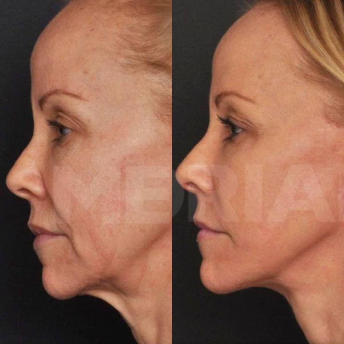 Case 18347 - deep plane facelift