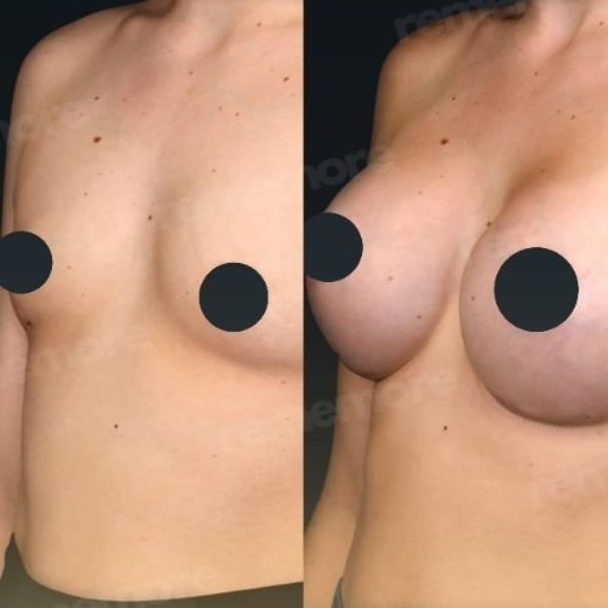 Case 18348 - breast augmentation