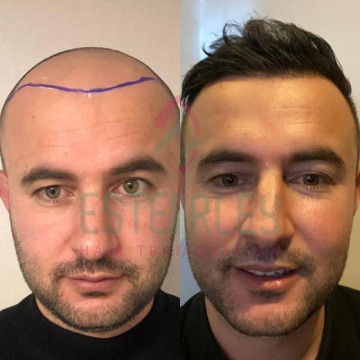 Case 18436 - DHI hair transplant
