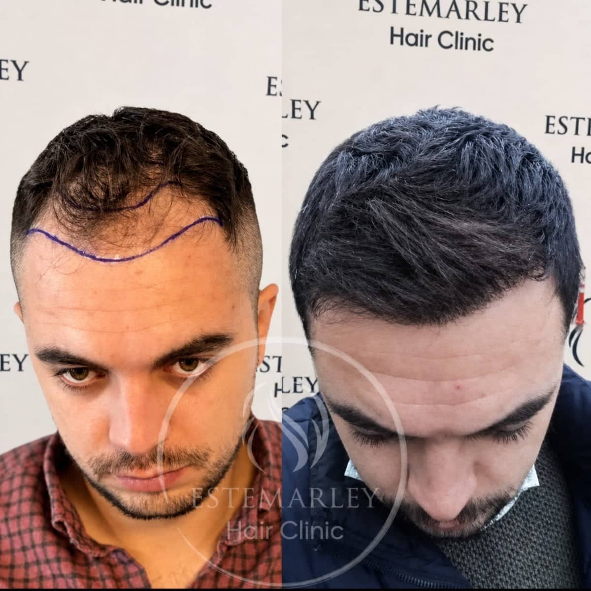 Case 18437 - hair transplant