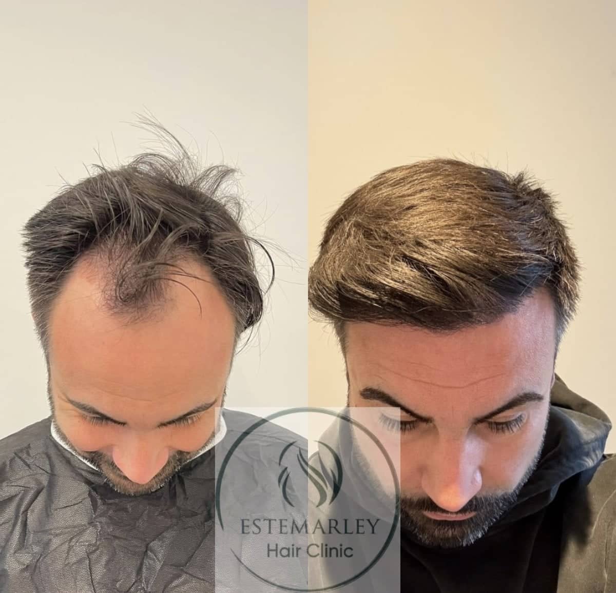 Case 18439 - DHI hair transplant