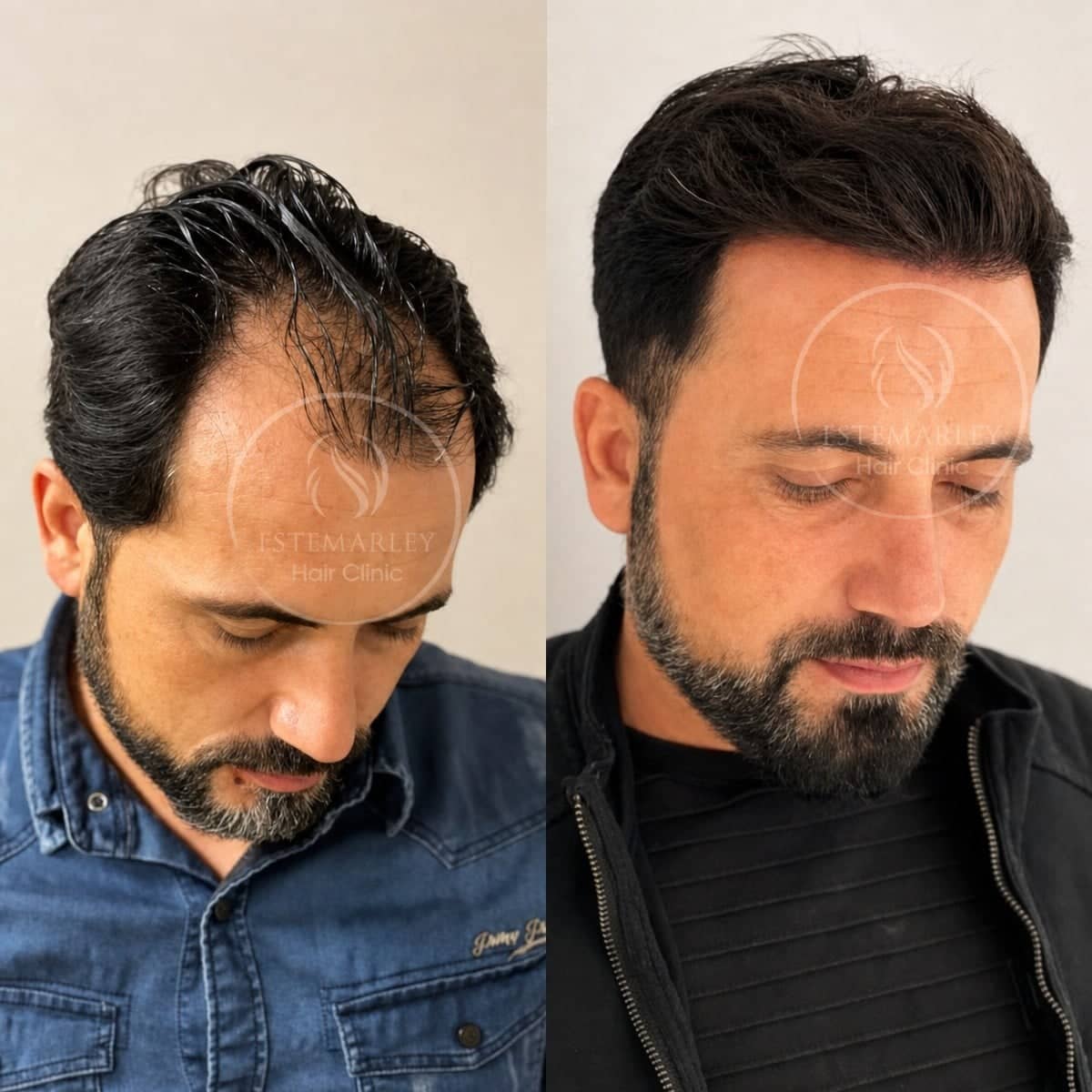 Case 18440 - DHI hair transplant