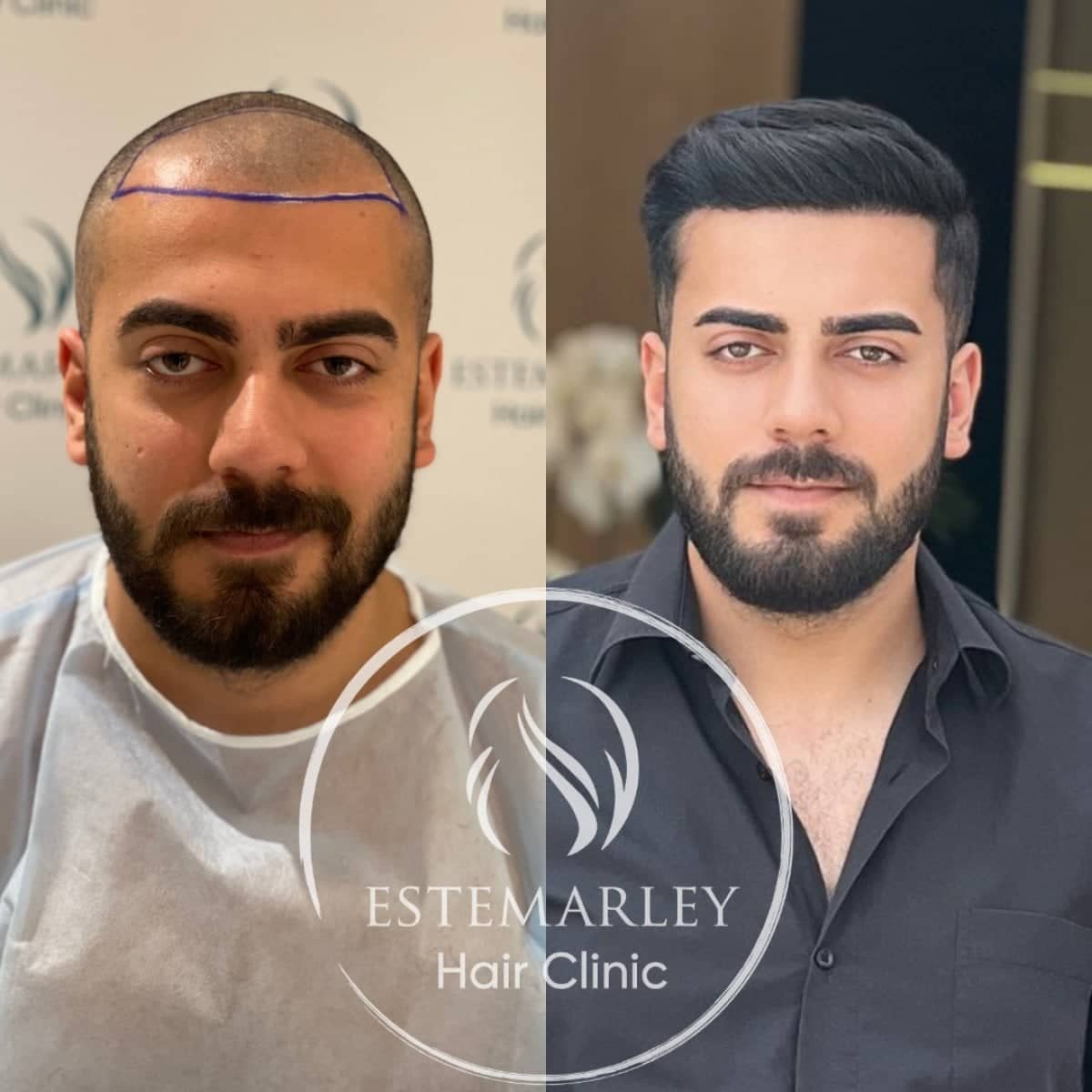 Case 18441 - hair transplant
