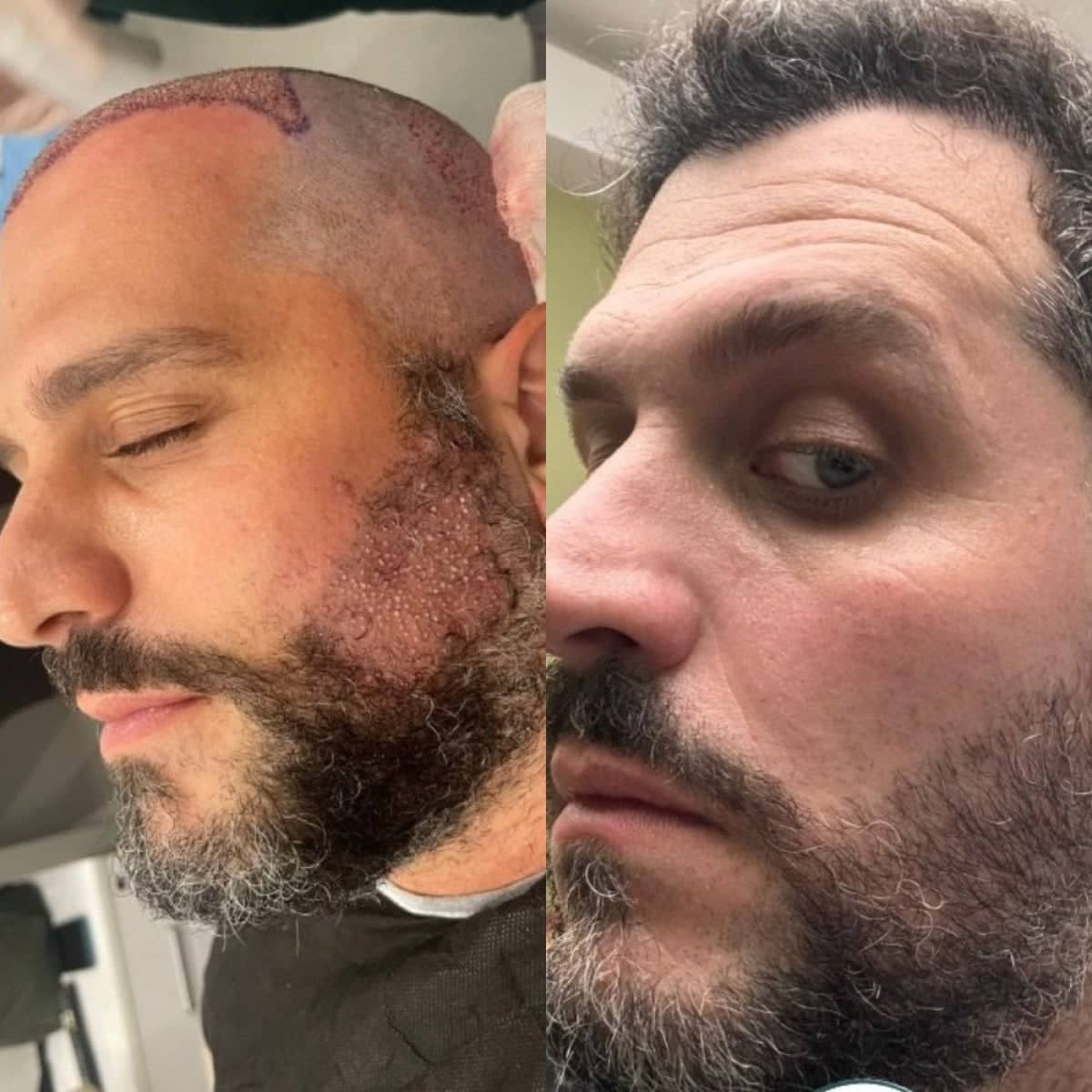 Case 18442 - beard transplant