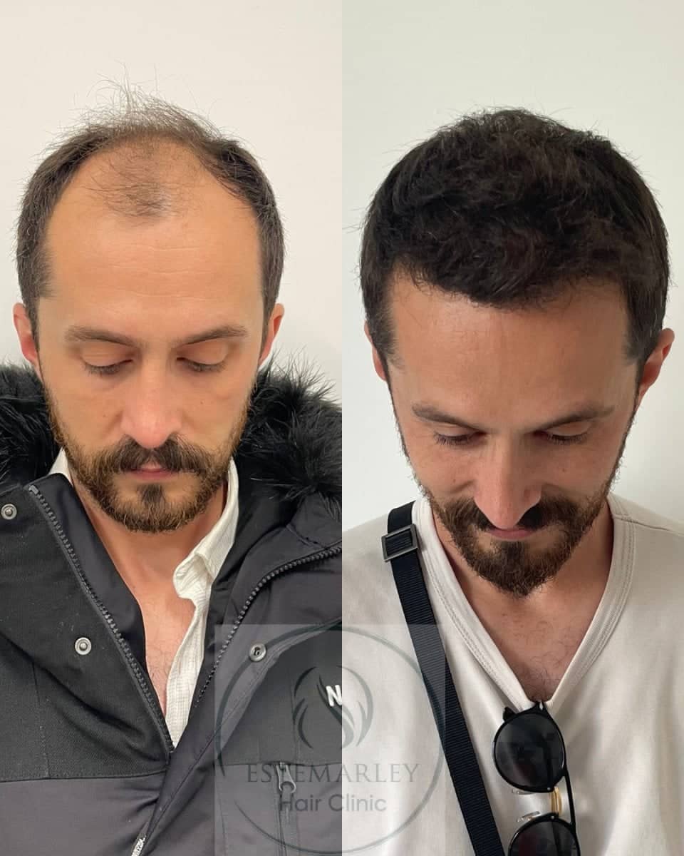 Case 18443 - DHI hair transplant