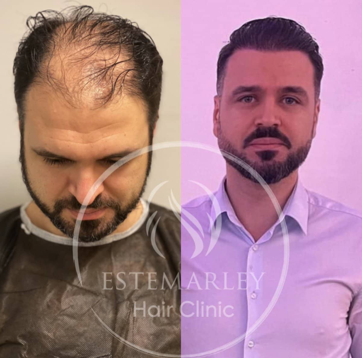 Case 18447 - hair transplant