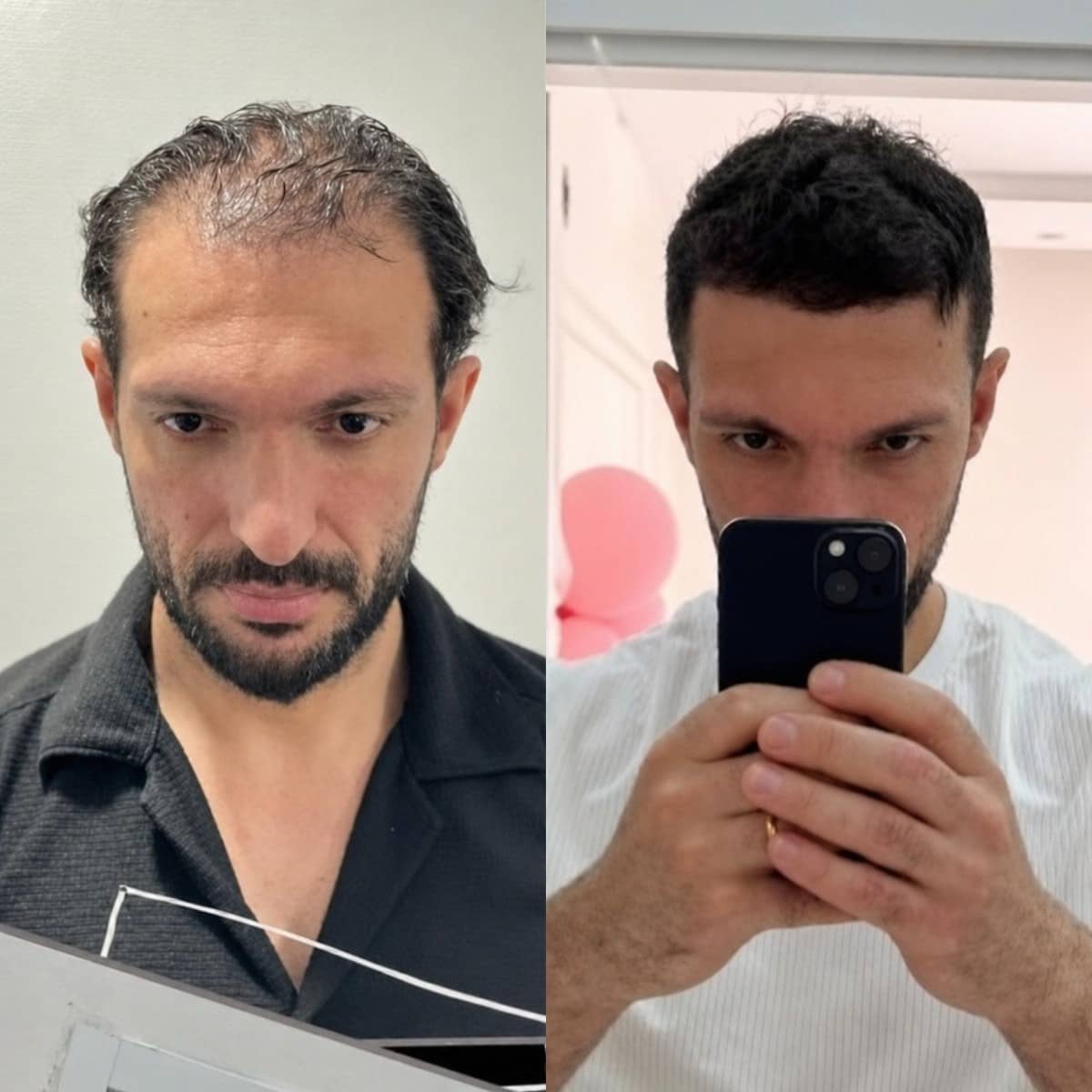 Case 18448 - hair transplant