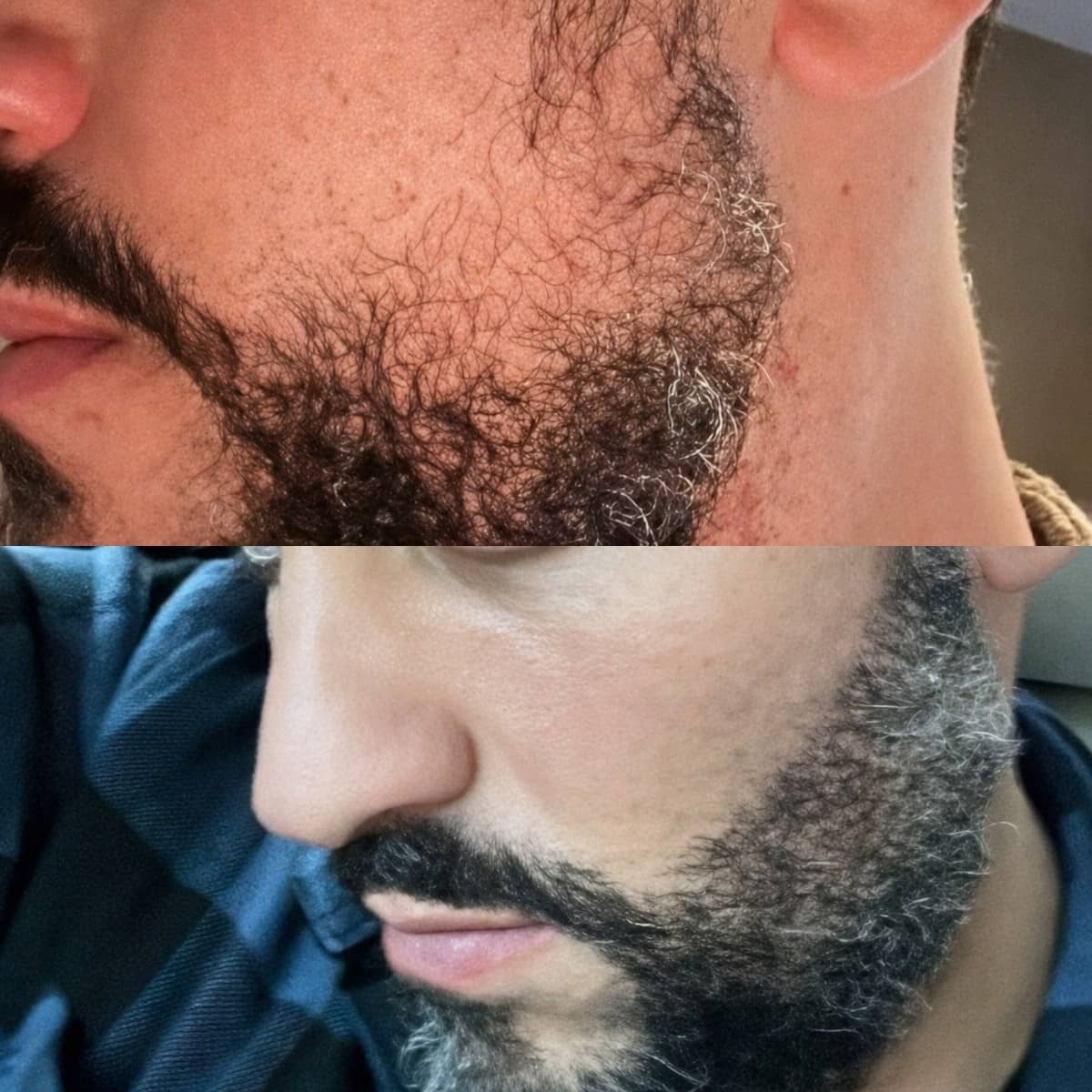 Case 18449 - beard transplant