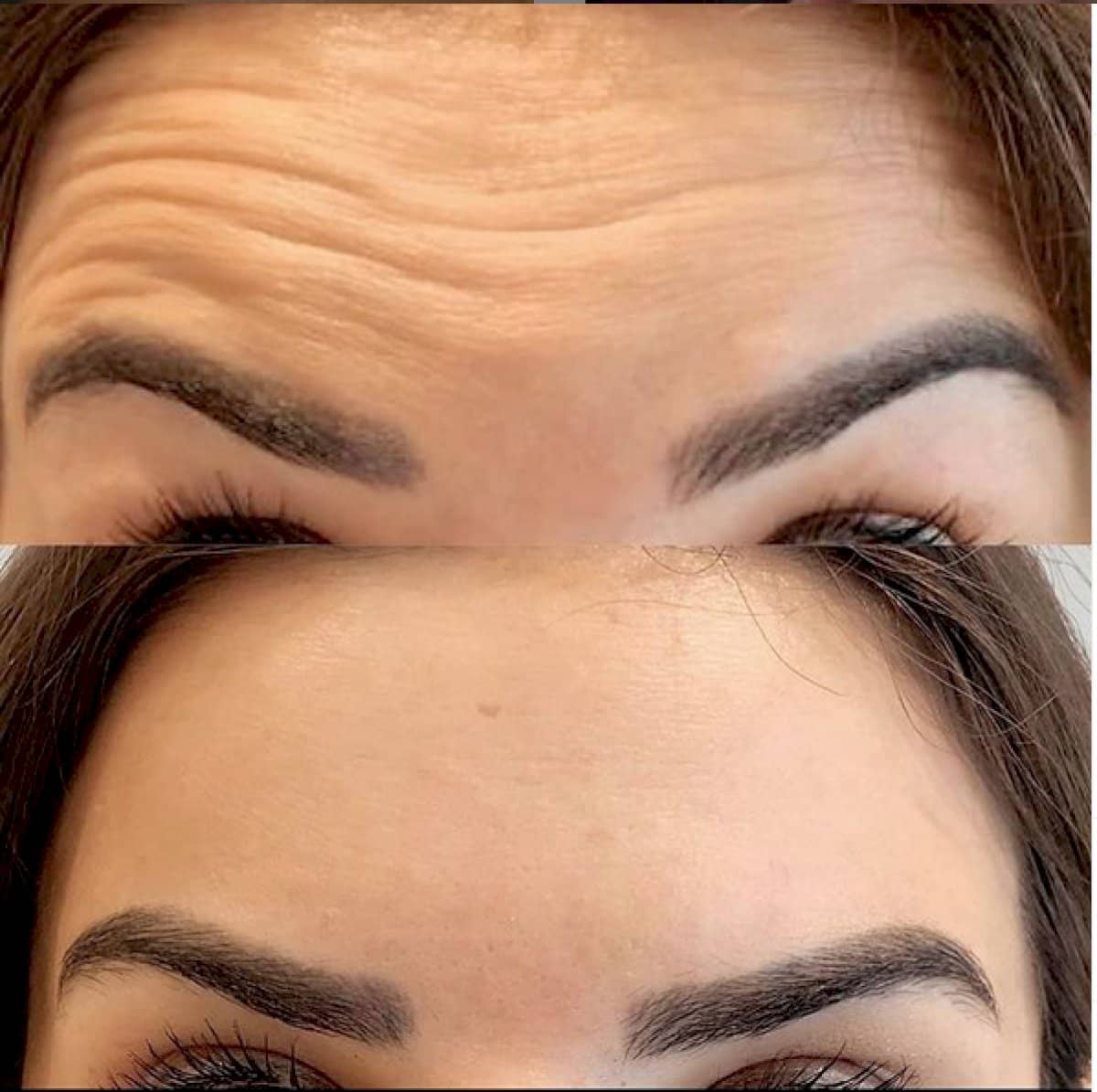 Case 18453 - Botox injections