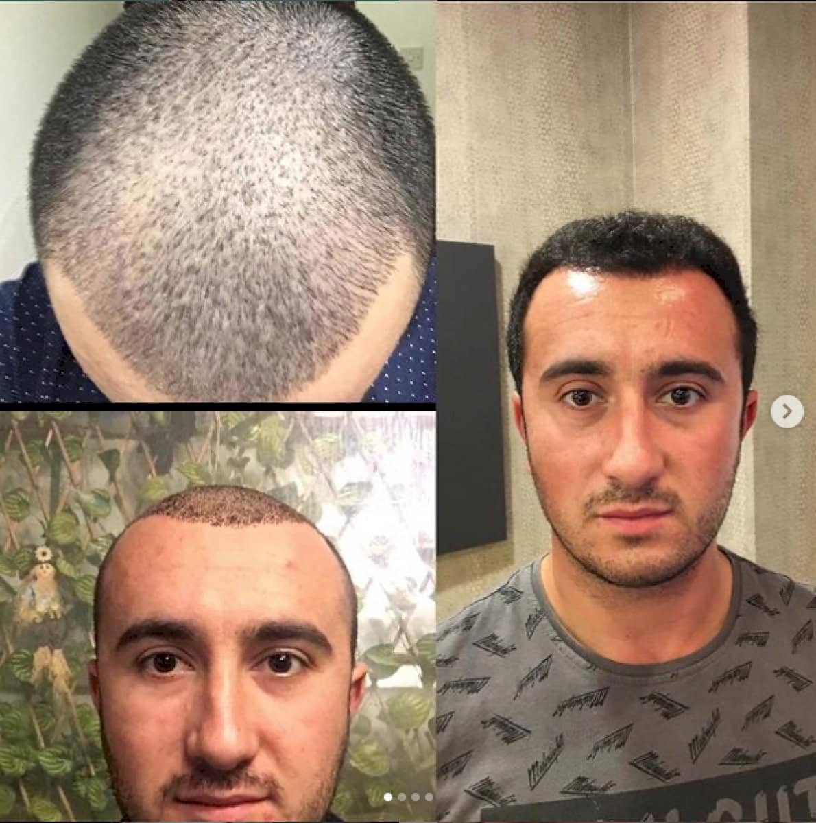 Case 18454 - hair transplant