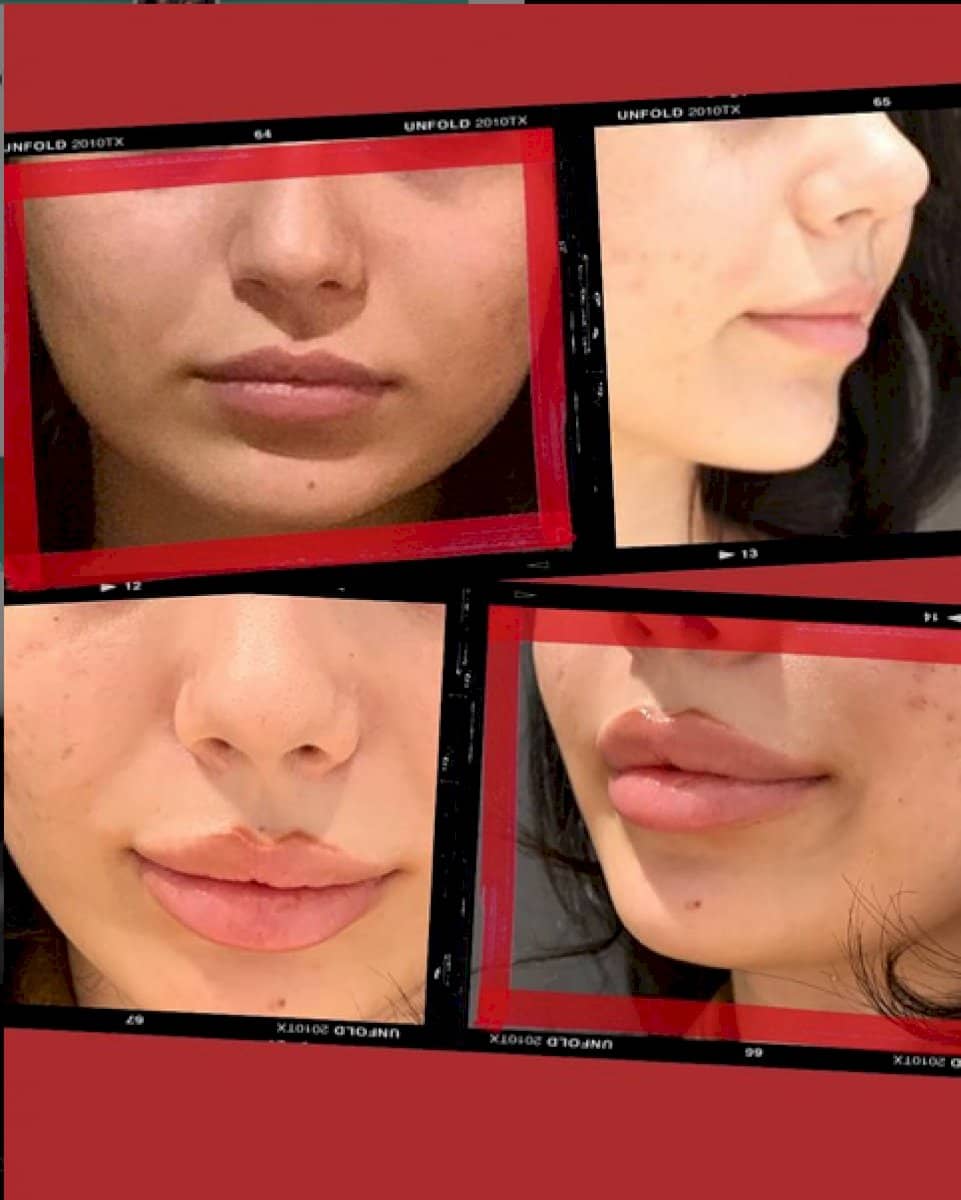 Case 18455 - lip fillers injection
