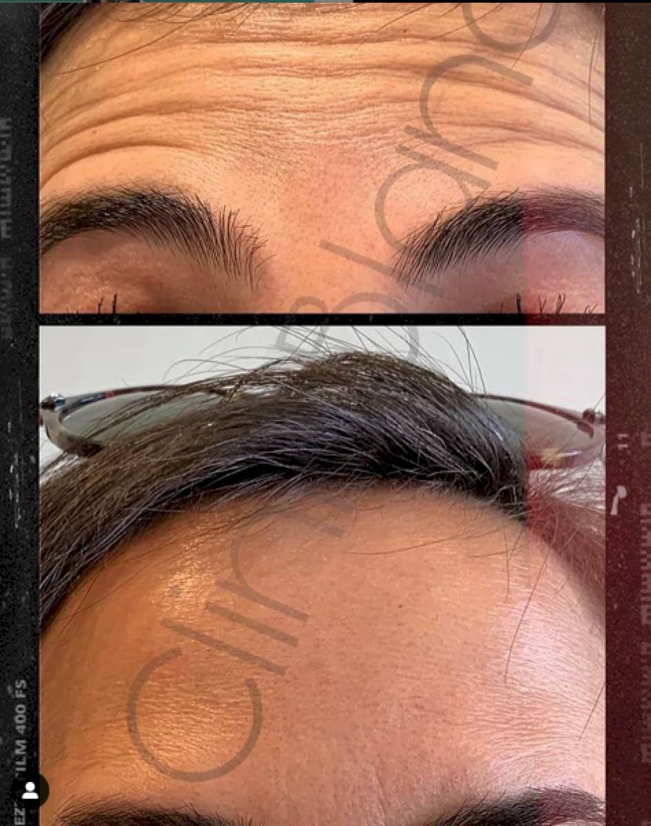 Case 18456 - Botox injections