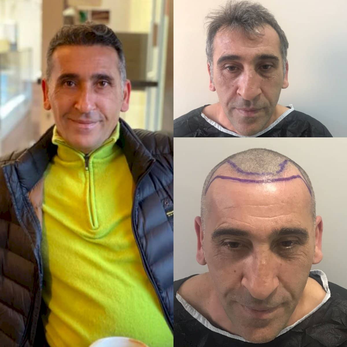 Case 18457 - hair transplant