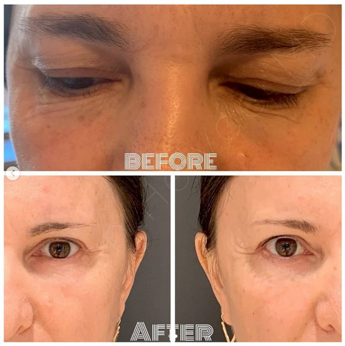 Case 18458 - Botox injections