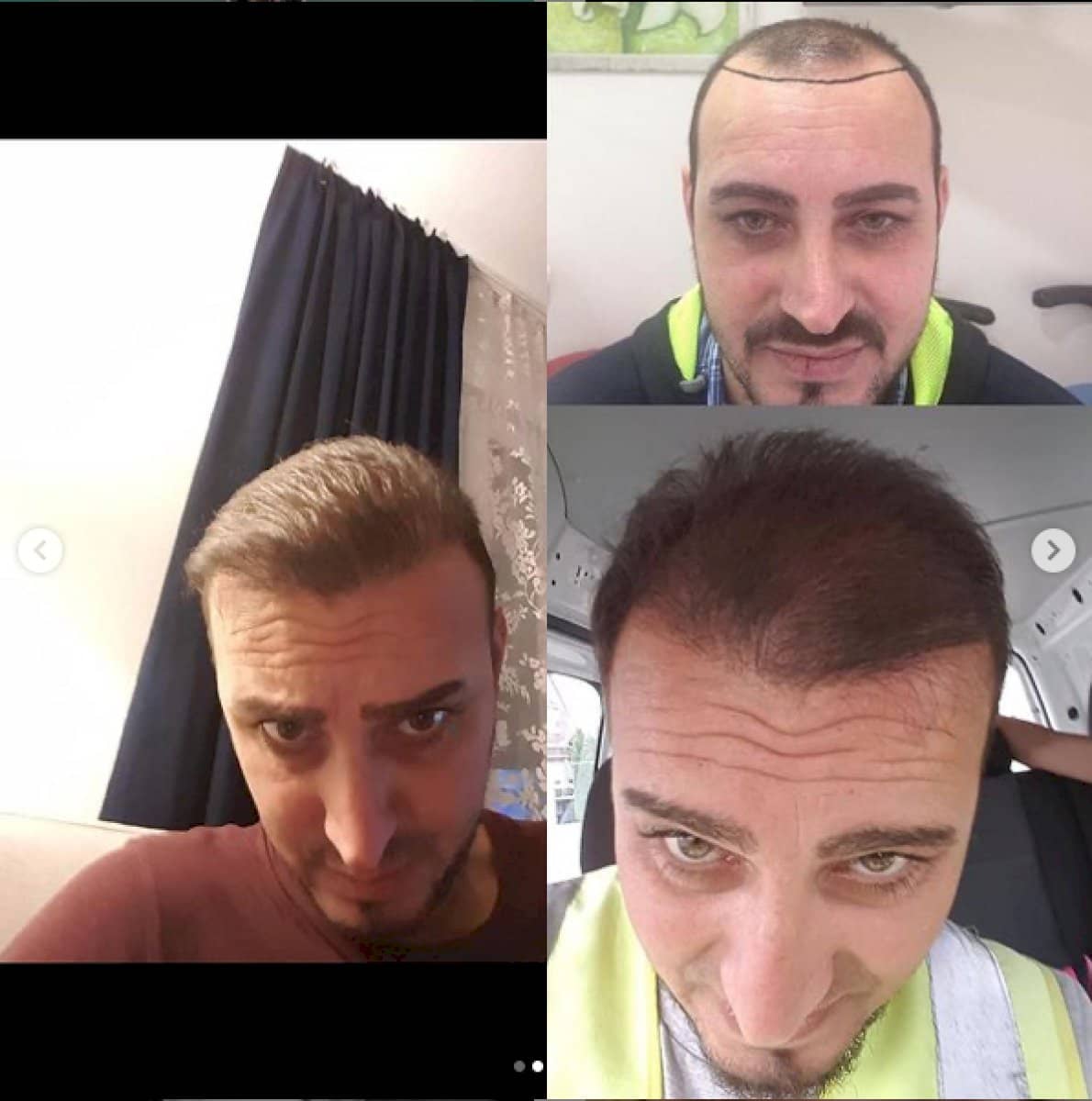 Case 18459 - hair transplant