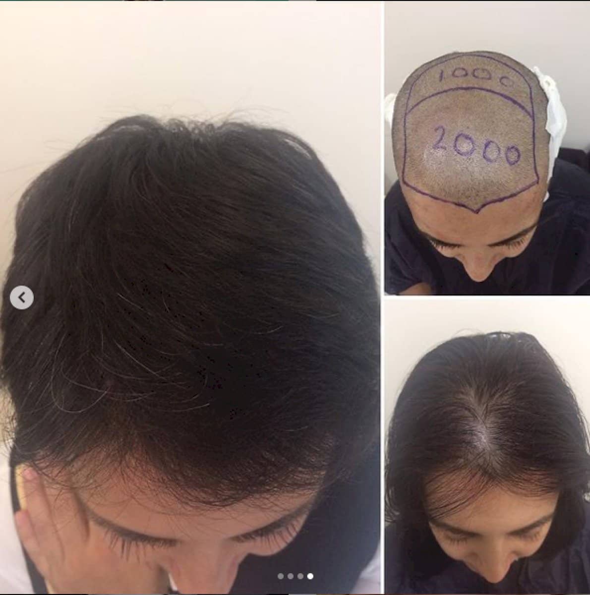 Case 18462 - hair transplant