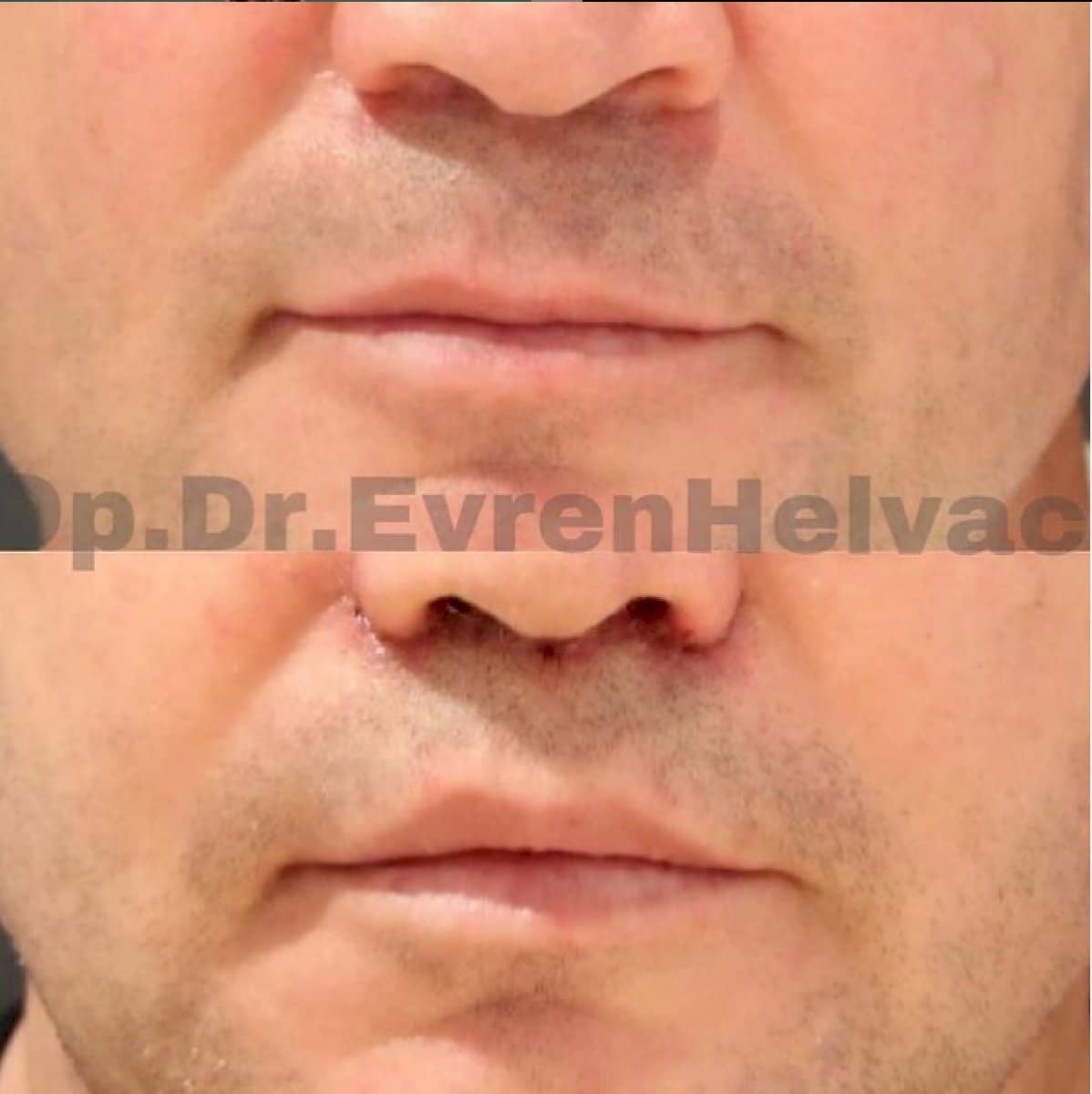 Case 18465 - Botox injections