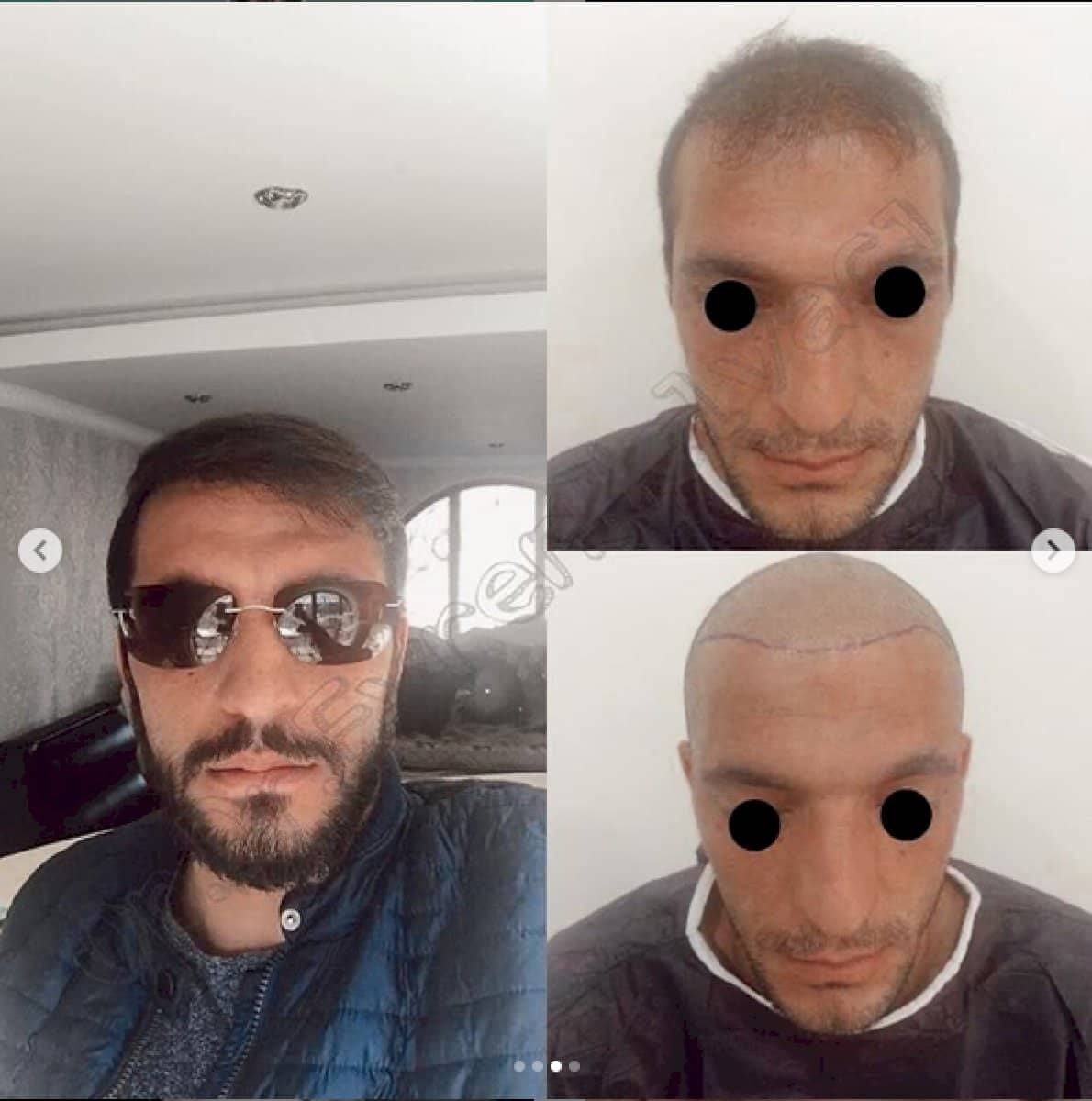 Case 18466 - hair transplant