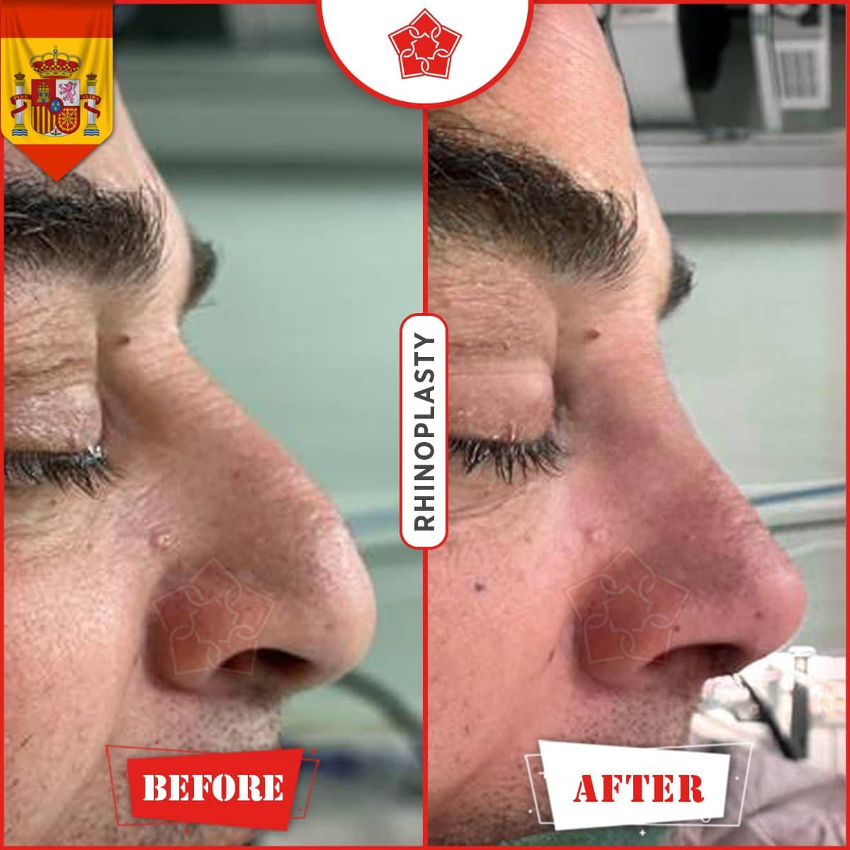 Case 18518 - rhinoplasty