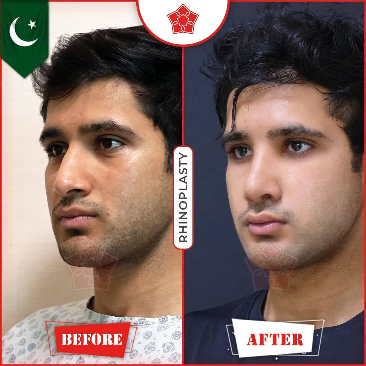Case 18520 - rhinoplasty