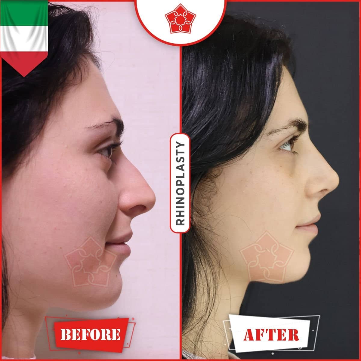 Case 18521 - rhinoplasty