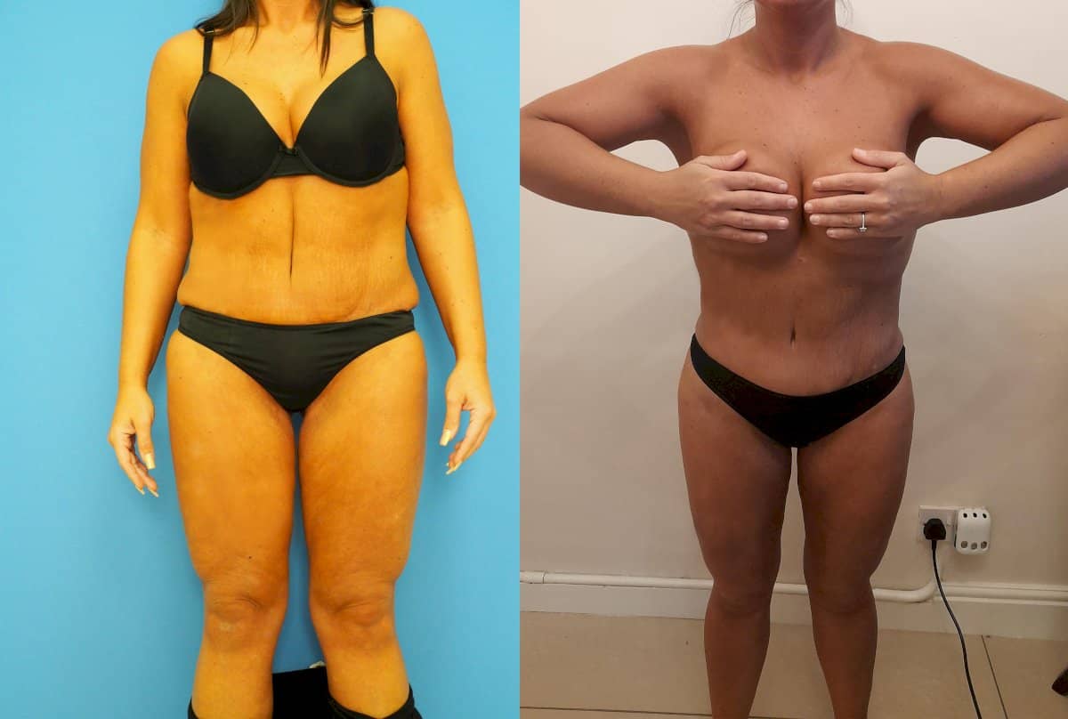 Case 18526 - liposuction