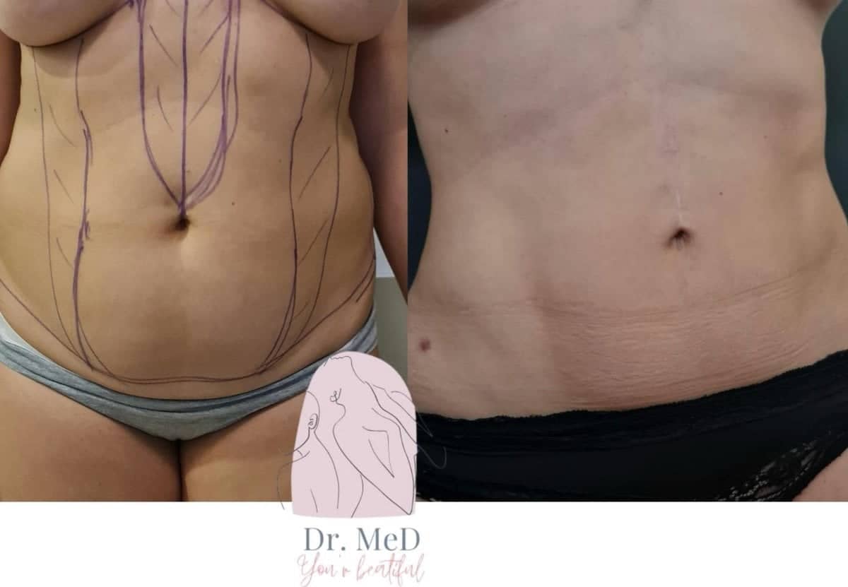 Case 18577 - Vaser liposuction