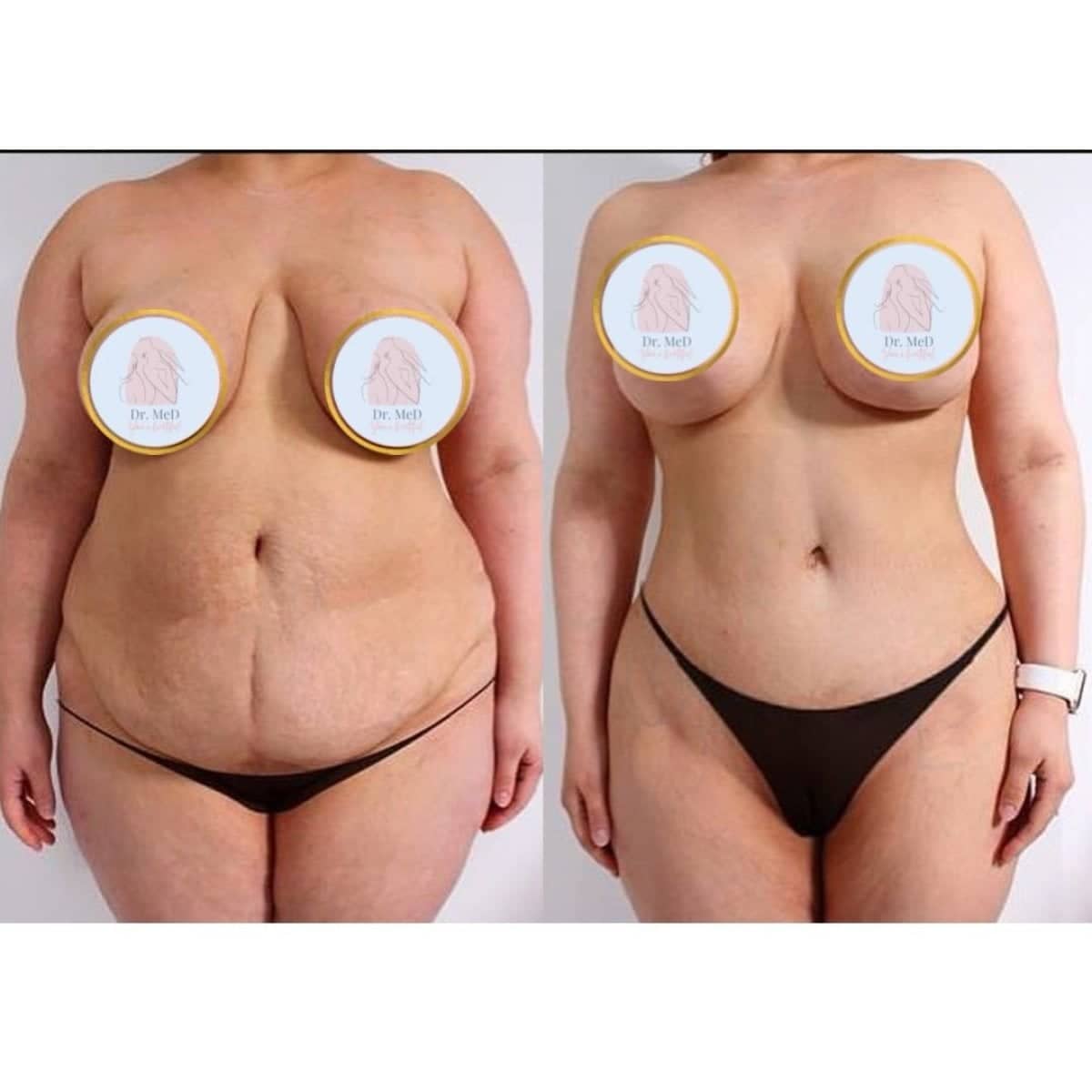 Case 18578 - breast lift