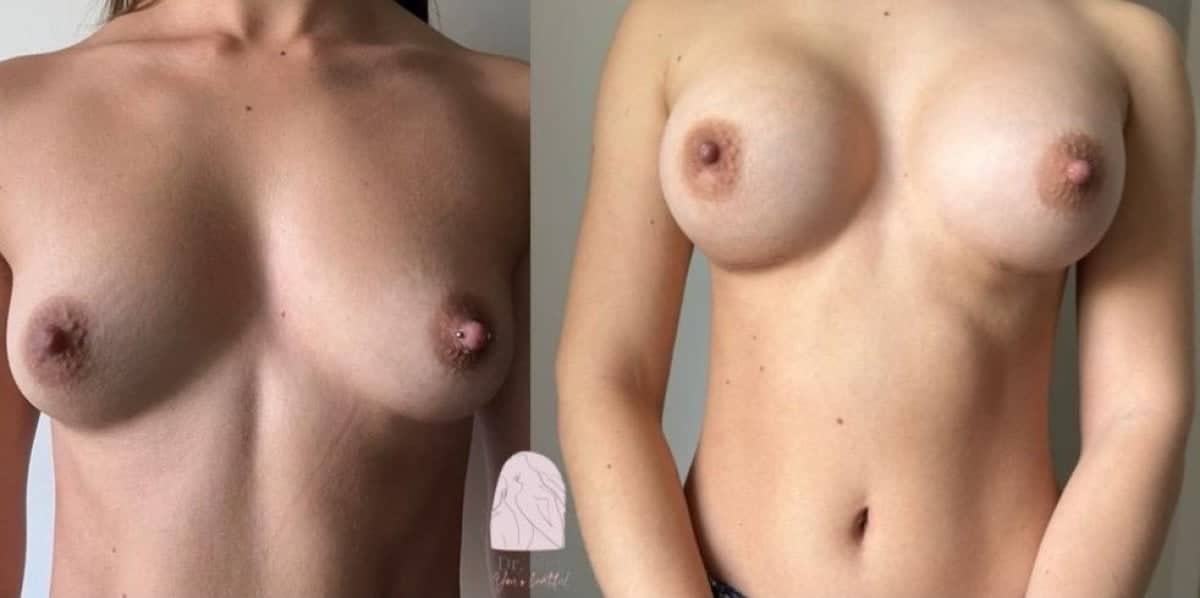 Case 18579 - breast augmentation