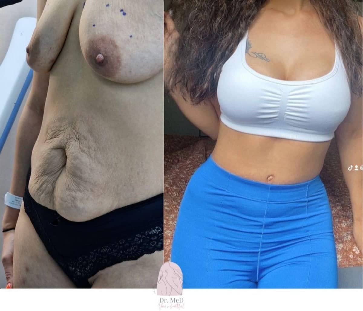 Case 18580 - mommy makeover