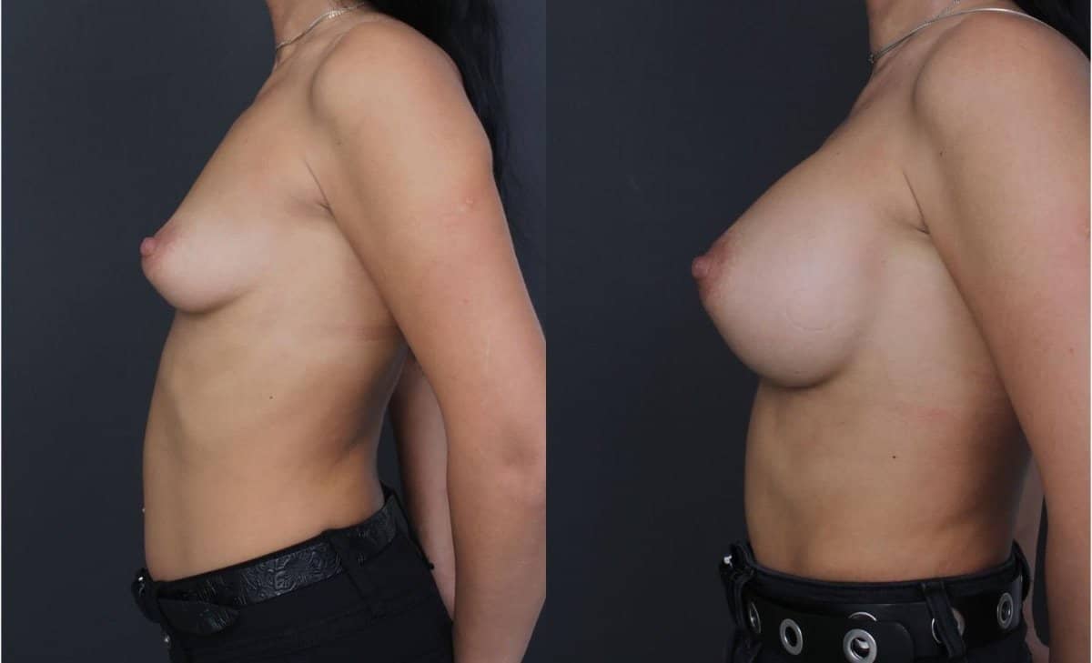 Case 18581 - breast augmentation