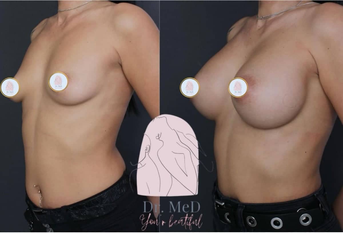 Case 18582 - breast augmentation